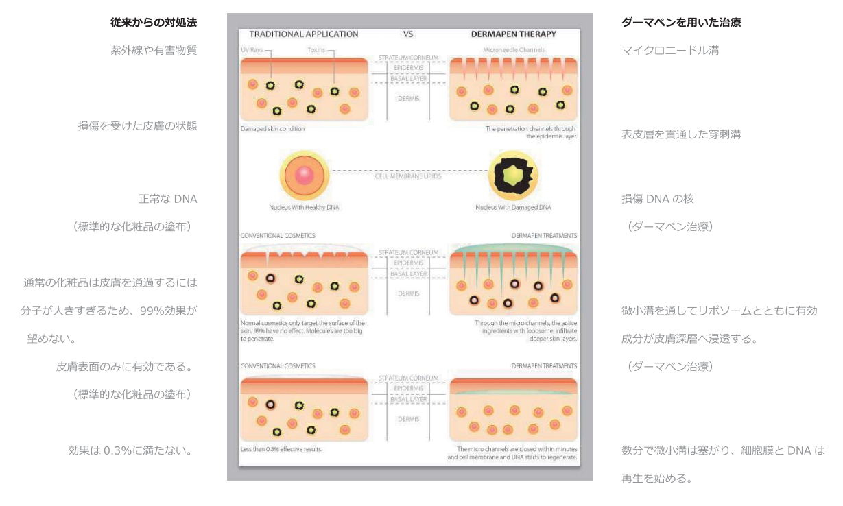 ダーマペン穿刺深度チャート