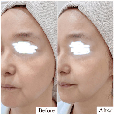 症例写真2 before：顔全体施術直前　after：治療5分後