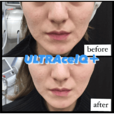 症例写真 before：顔全体施術直前　after：治療5分後